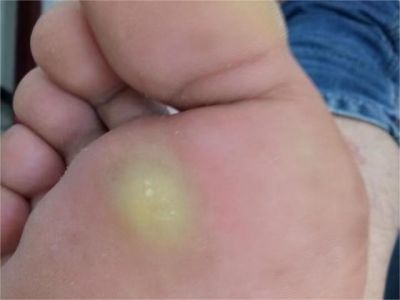 胼胝腳底和大腳趾上有黃色硬塊圖
