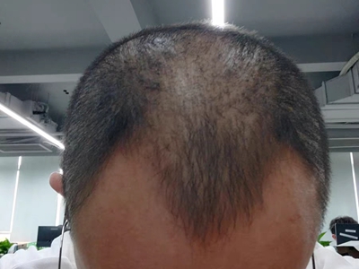 雄激素性脫髮額頭兩邊脫髮圖 雄激素性脫髮額頭兩邊脫髮圖