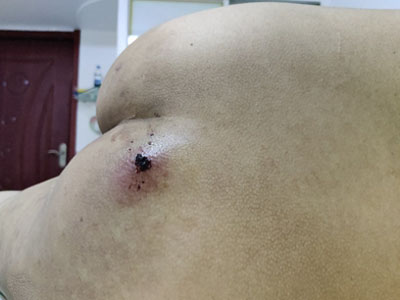 皮脂腺囊腫臀部局部結痂圖 皮脂腺囊腫臀部局部結痂圖
