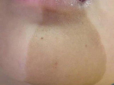 咖啡斑下巴處長大片淡褐色斑塊圖