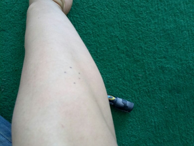 硬腫病胳膊有點腫脹難受得慌圖