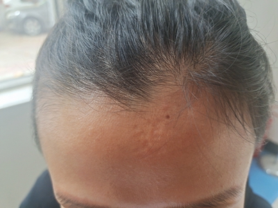 萎縮性瘢痕前額有略凹陷的瘢痕圖 萎縮性瘢痕前額有略凹陷的瘢痕圖