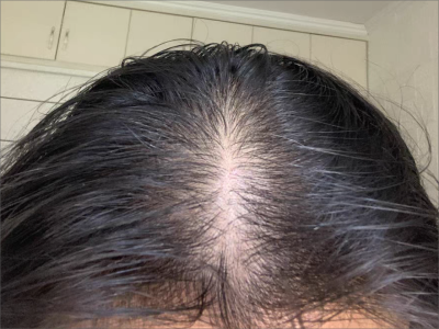 雄激素性脫髮頭頂發縫逐漸變寬圖