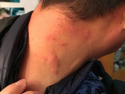 色素性痒疹後頸部凸起的紅疙瘩圖
