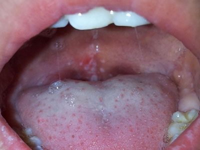 愛滋病感染性皮膚損害咽喉潰瘍圖 愛滋病感染性皮膚損害咽喉潰瘍圖