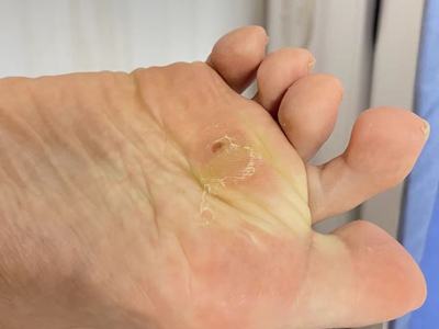 胼胝腳底發黃有硬結圖 胼胝腳底發黃有硬結圖
