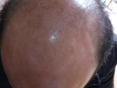 雄激素性脫髮頭頂只有幾根頭髮圖