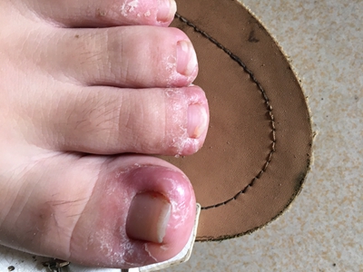 嵌甲腳趾腫脹變形圖 嵌甲腳趾腫脹變形圖