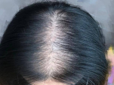 女性型脫髮頭頂發縫處頭髮稀疏圖