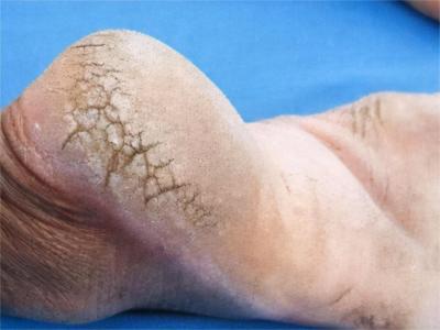 手足皸裂腳後跟好多裂口圖 手足皸裂腳後跟好多裂口圖