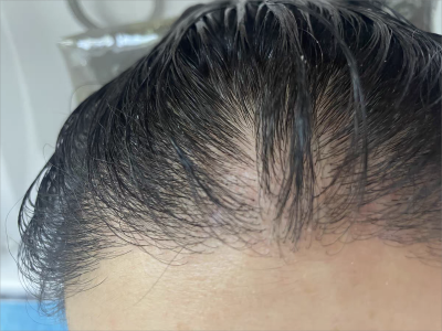 雄激素性脫髮前額頭髮油膩稀少圖