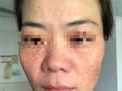 雀斑面部密密麻麻都是褐色斑點圖 雀斑面部密密麻麻都是褐色斑點圖
