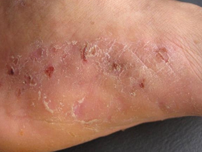 愛滋病腳底一側脫皮結痂圖
