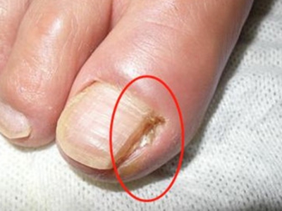 嵌甲大腳趾邊緣流膿圖