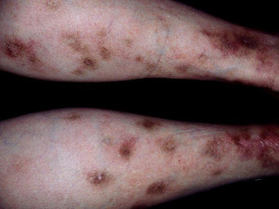 硬結性紅斑小腿上結痂顏色加深圖