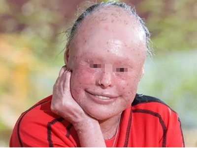 先天性外胚葉發育不良面部異常圖