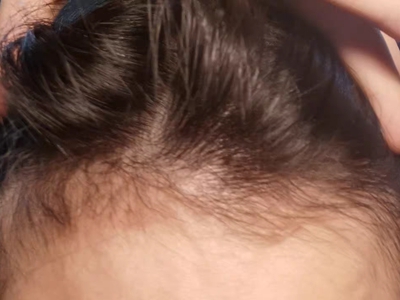 雄激素性脫髮額角處頭髮減少圖