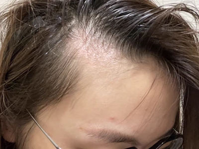 雄激素性脫髮額角頭髮少圖