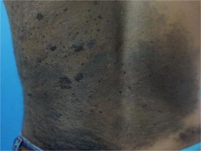 獸皮痣後背皮膚黑並且長毛圖