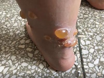 蠓蟲叮咬小腿有大水皰圖 蠓蟲叮咬小腿有大水皰圖