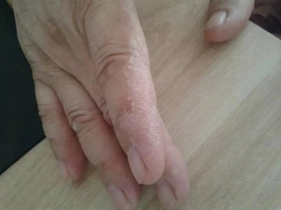 手部濕疹手掌水皰乾涸圖 手部濕疹手掌水皰乾涸圖