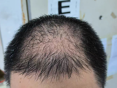 雄激素性脫髮頭髮日漸稀少圖 雄激素性脫髮頭髮日漸稀少圖