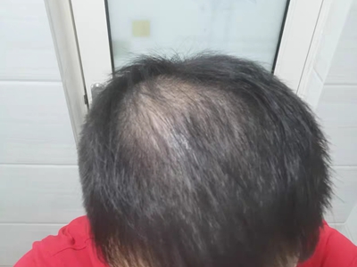 雄激素性脫髮頭頂頭髮變稀疏圖 雄激素性脫髮頭頂頭髮變稀疏圖