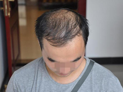 雄激素性脫髮頭頂頭髮越來越少圖