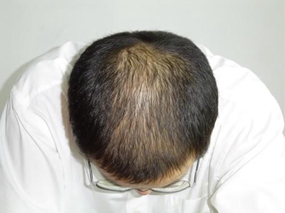雄激素性脫髮早期圖 雄激素性脫髮早期圖