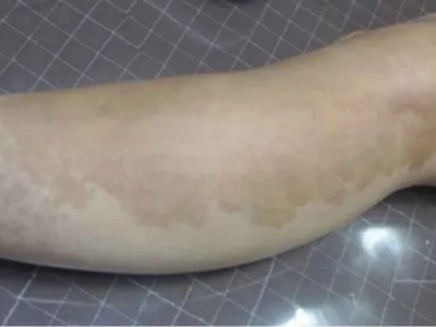 咖啡斑小腿上有大片咖啡色斑圖