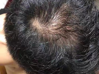 雄激素性脫髮頭頂發旋處脫髮圖