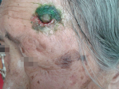 愛滋病皮膚腫瘤前額長結節破潰圖 愛滋病皮膚腫瘤前額長結節破潰圖