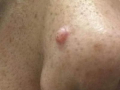 小汗腺汗孔瘤鼻翼有個小疙瘩圖