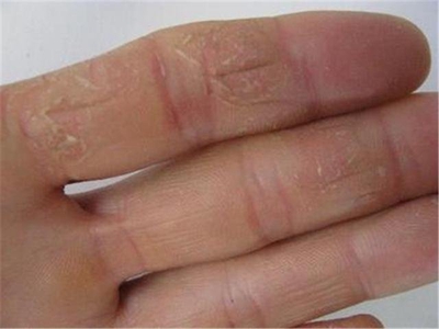 手部濕疹手指皮膚增厚脫皮圖