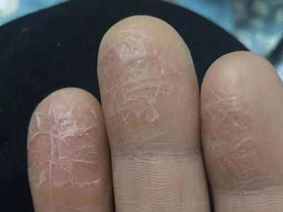 手部濕疹右手手指尖處有脫皮圖