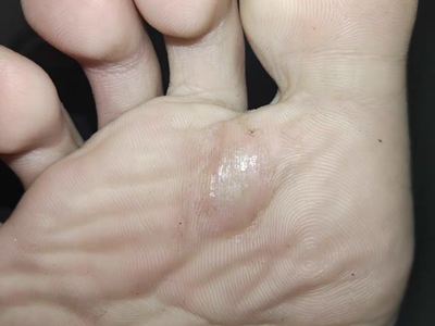 胼胝腳掌上有個粗糙的硬塊圖