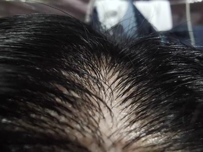 女性型脫髮頭髮稀疏很油圖 女性型脫髮頭髮稀疏很油圖