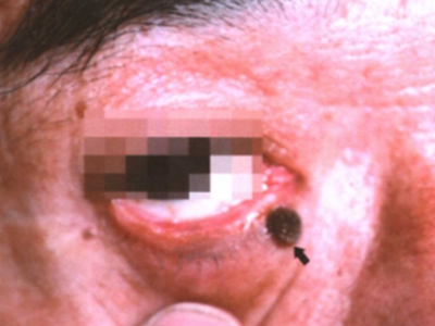 愛滋病眼角小黑點圖 愛滋病眼角小黑點圖