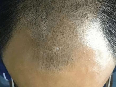 男性型脫髮頭頂脫髮圖
