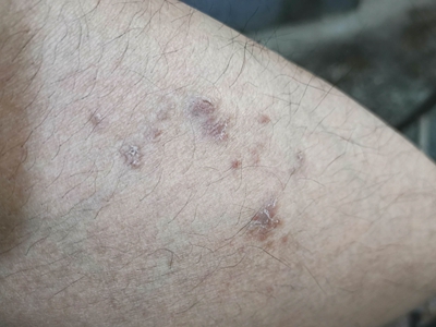 尋常型銀屑病小腿上起褐色皮疹圖