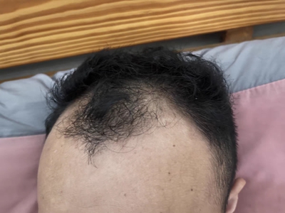 雄激素性脫髮前額大範圍脫髮圖