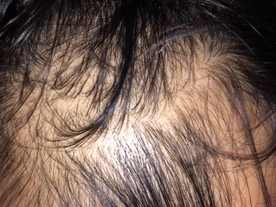 男性型脫髮頭頂頭髮脫落露頭皮圖 男性型脫髮頭頂頭髮脫落露頭皮圖