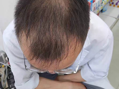 雄激素性脫髮頭頂的頭髮很稀疏圖
