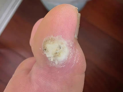 胼胝大腳趾上有個硬塊起皮圖