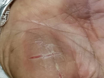 手足皸裂手掌有裂口圖