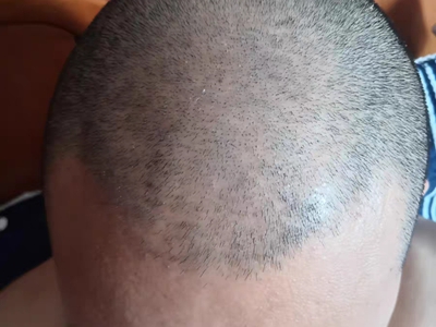 雄激素性脫髮額頭髮際線變高圖