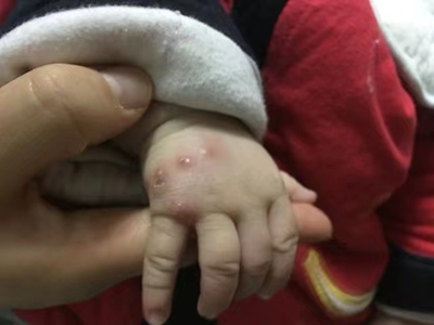 新生兒膿皰瘡手背上起皰圖