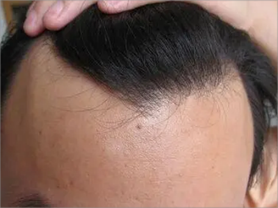 男性型脫髮額頭兩邊脫髮圖