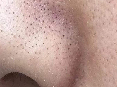 小棘毛壅病鼻翼黑色棘狀丘疹圖