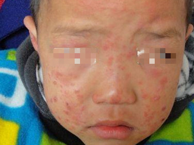 小兒過敏性紫癜面部長好多疹子圖